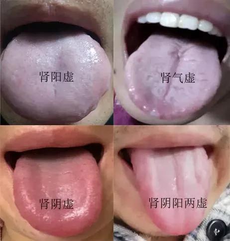 肾虚不仅影响身体健康，还可能导致一系列不适症状。今天，我们就来聊聊肾虚常见的四个
