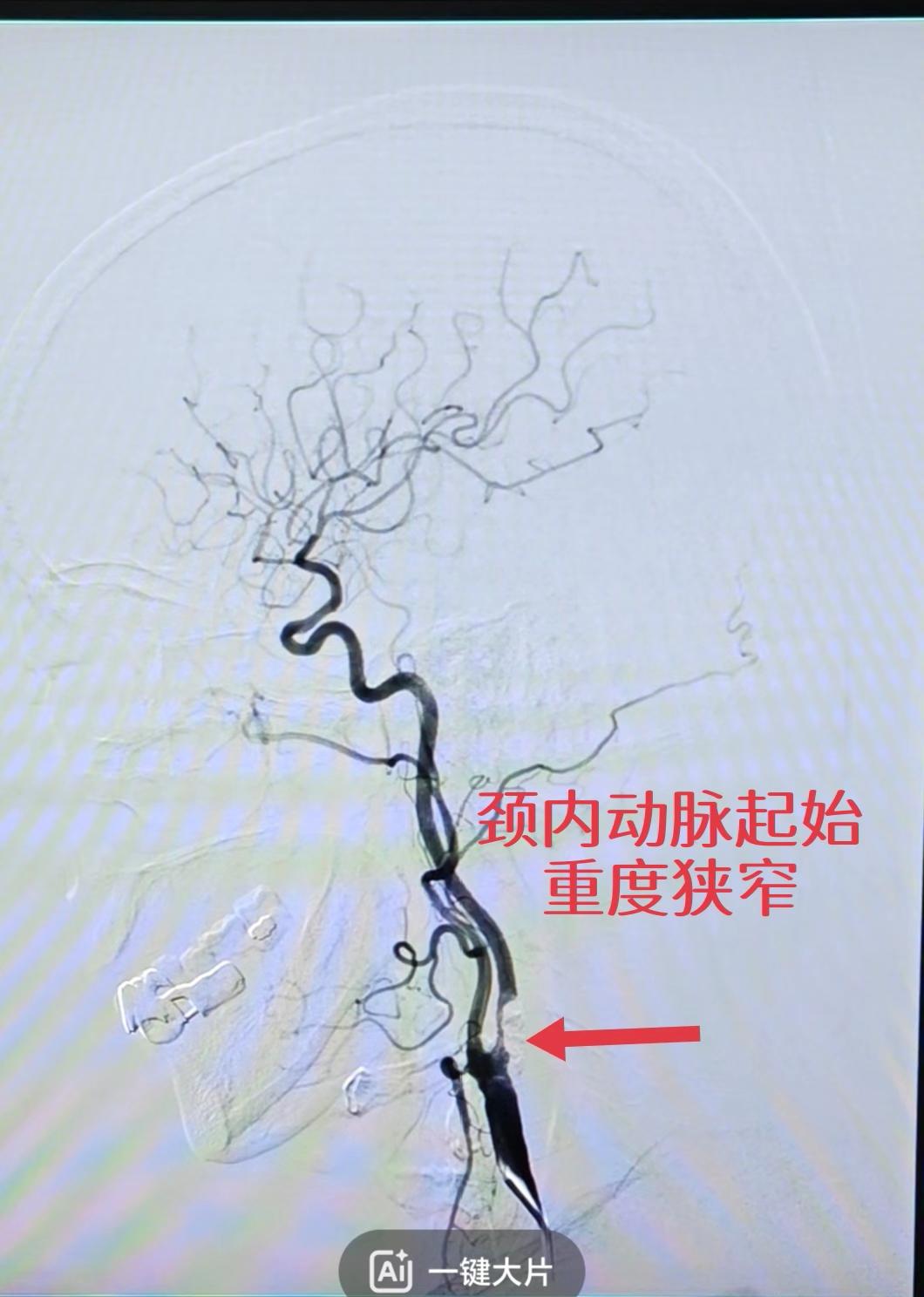 患者阵发性右侧肢体无力入院，考虑 短暂性脑缺血发作，头颈 CTA 提示...