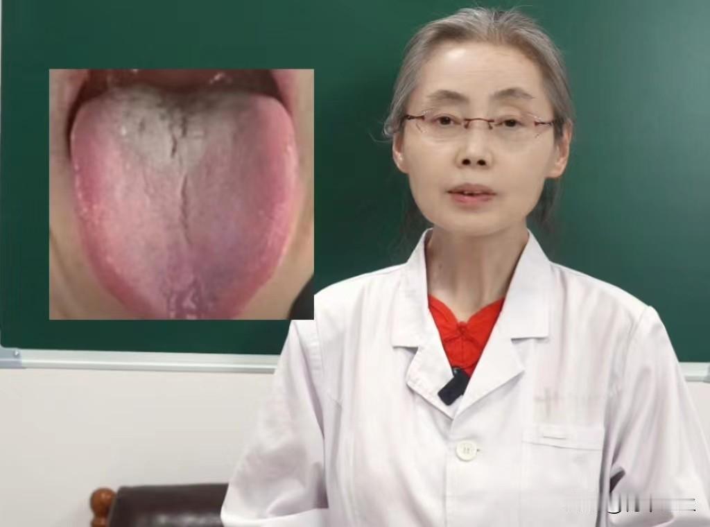 这种舌象，肾虚的厉害，还不能直接补，可真是愁人！

患者主诉：心理烦躁，焦虑不安