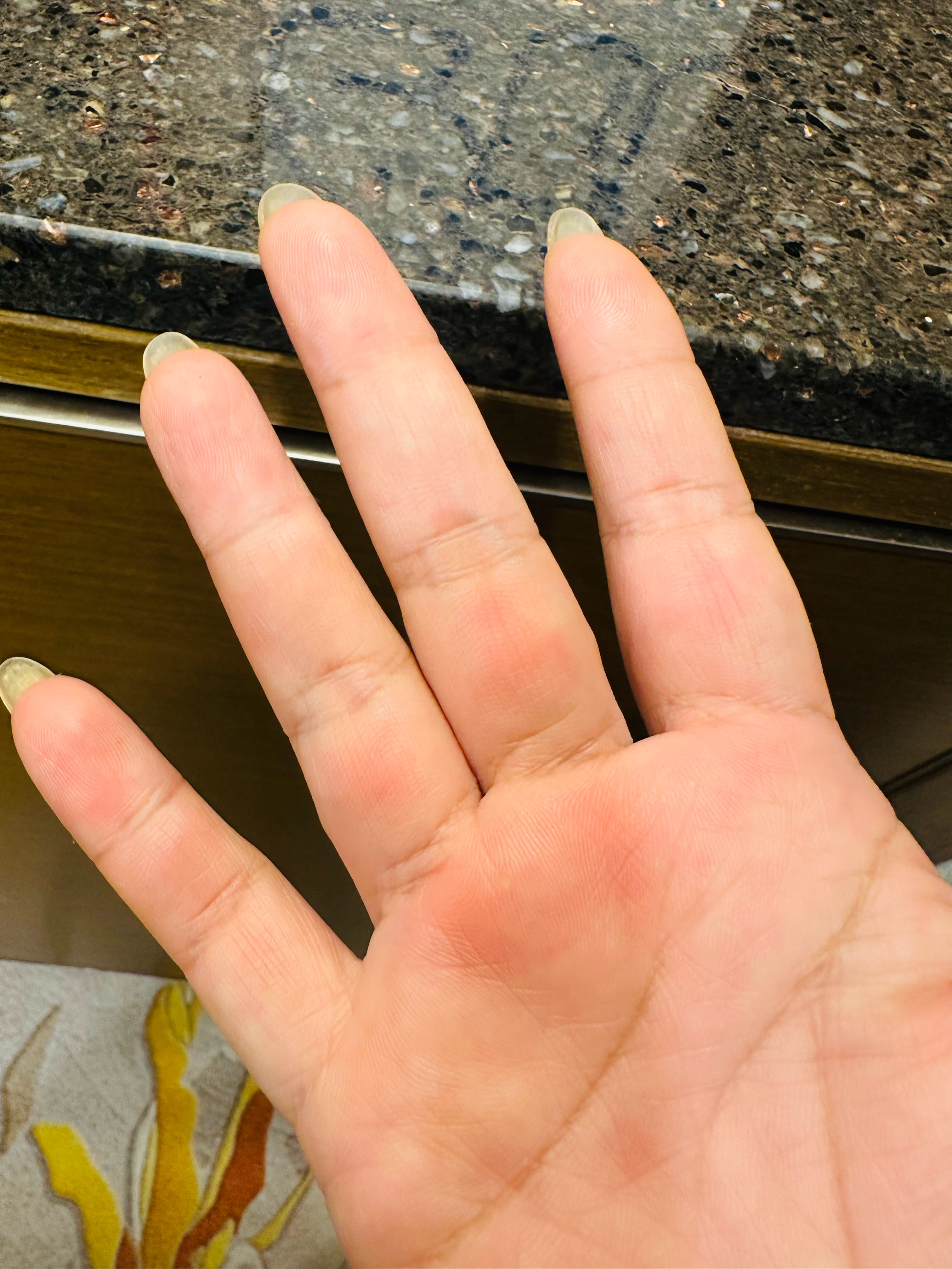 医生让我练一下单杠，我就试了试，全红了
