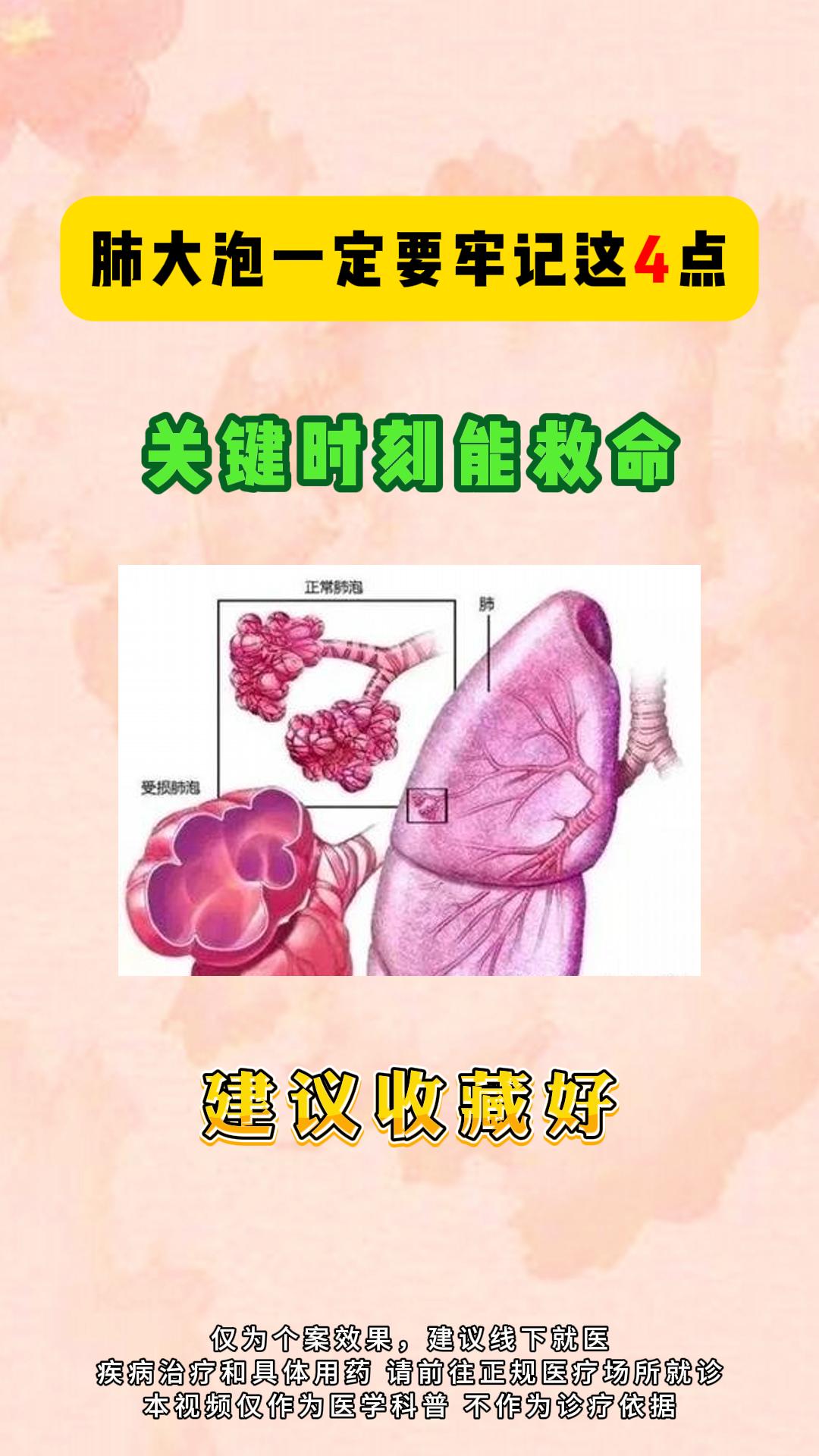 肺大泡一定要牢记这4点。