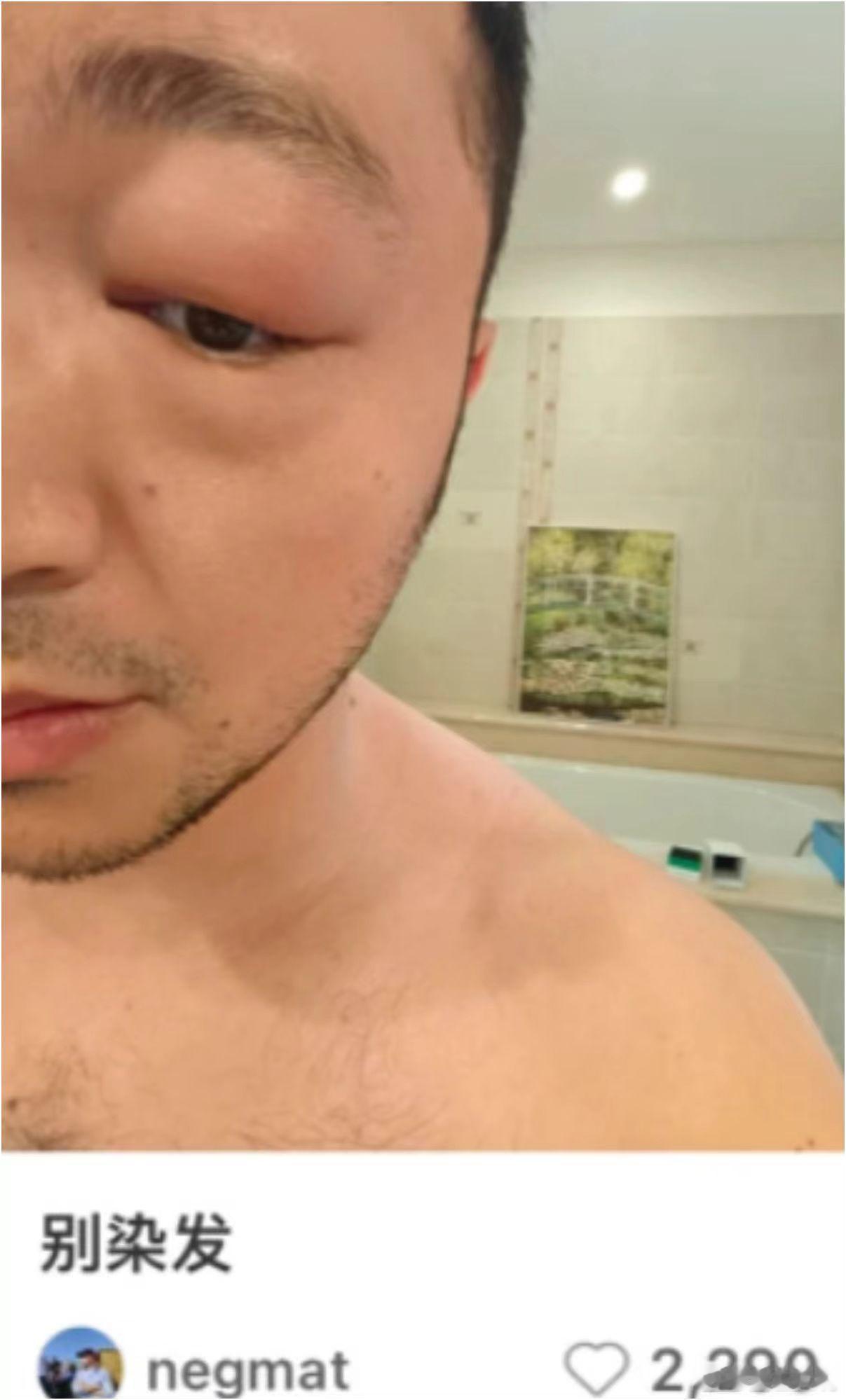 尼格买提晒染发照片主持人尼格买提晒染发后肿胀眼自拍 配文别染发太有梗 反差感十足