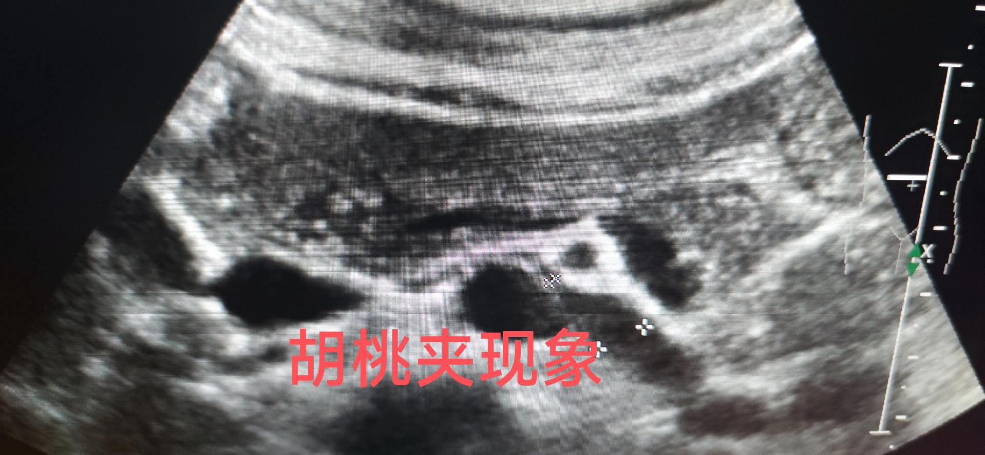胡桃夹现象超声。左肾静脉受压 女，41岁，血尿