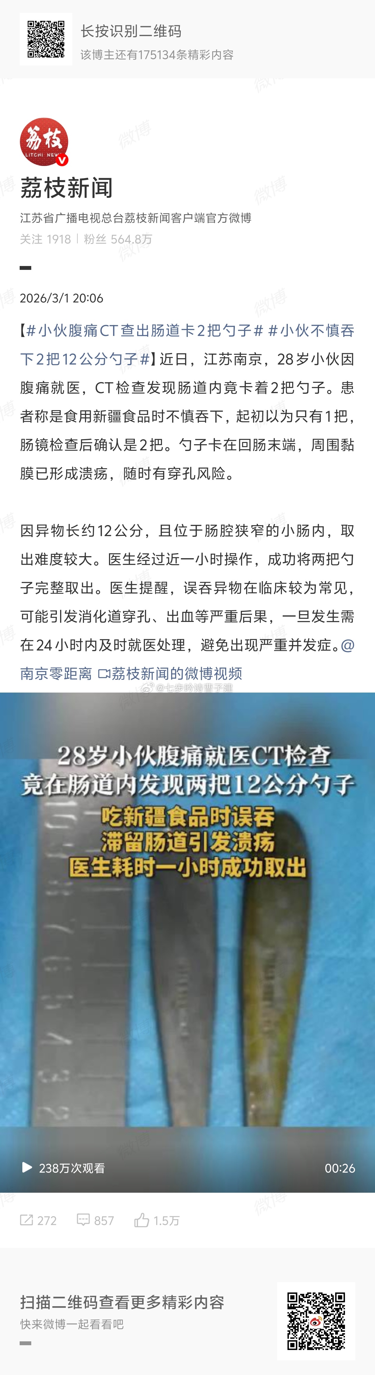 小伙腹痛CT查出肠道卡2把勺子哦，误食餐具 