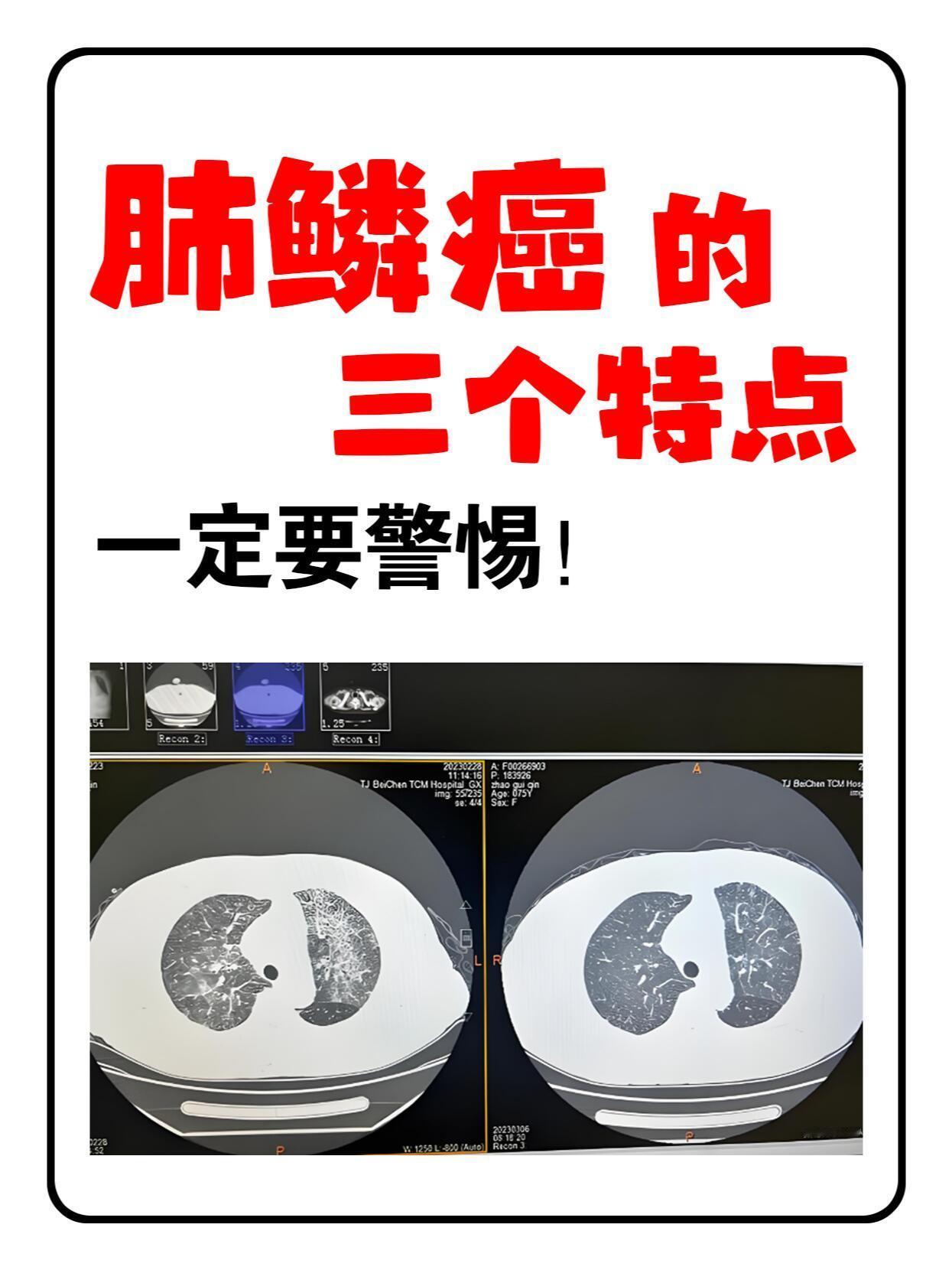 肺鳞癌的三个特点，一定要警惕！