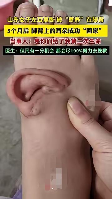 真敢想！医生把断耳“种”在脚背上，5个月后真“回家”了！

山东姑娘左耳意外离断