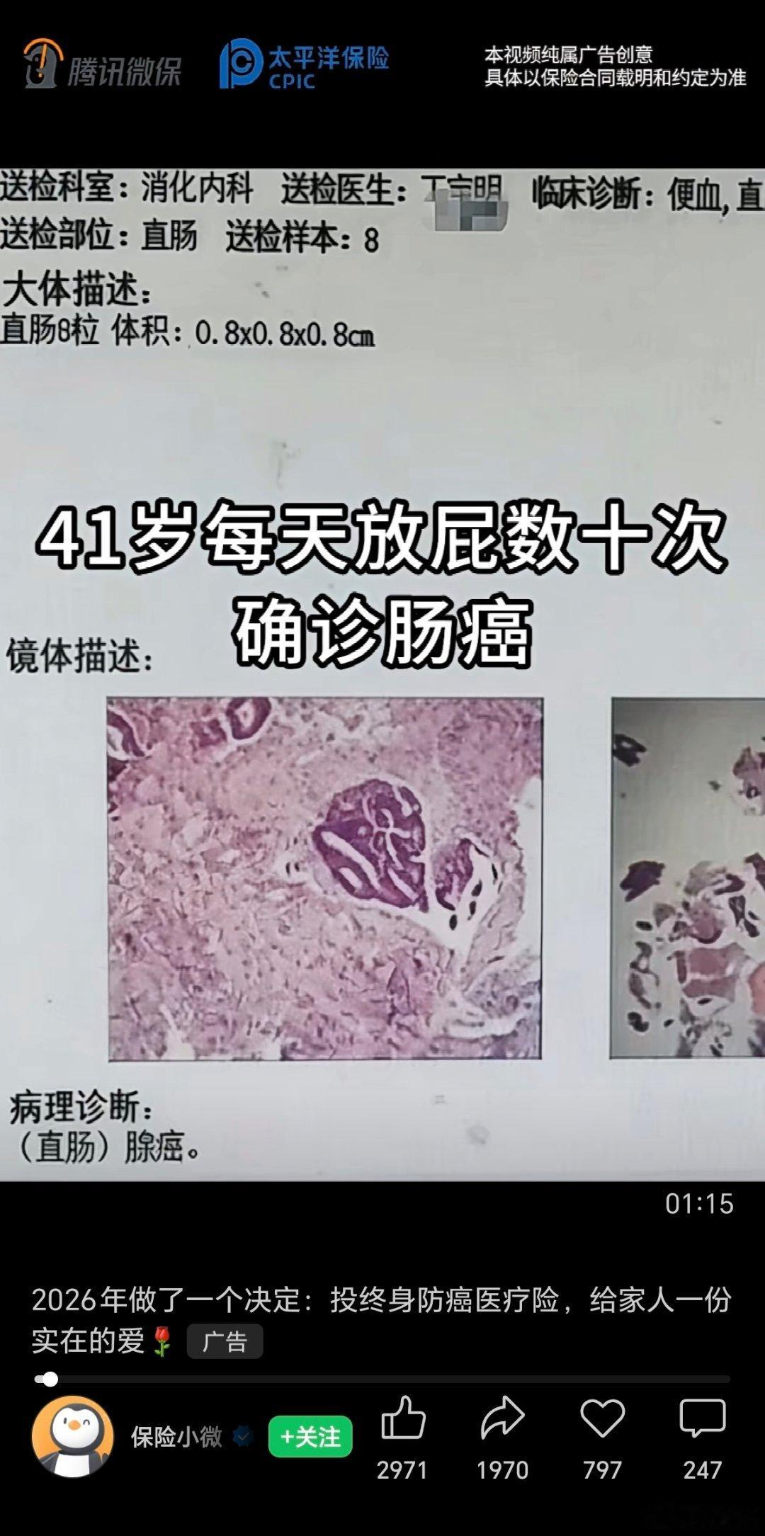 经常刷到微信视频号推送“肠癌”相关的视频，还好我前几天做了肠胃镜和结肠息肉，不然