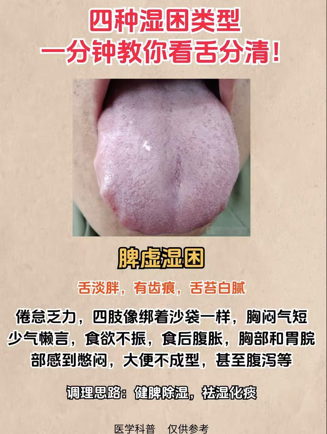 四种湿困类型，一分钟教你看舌分清！！！