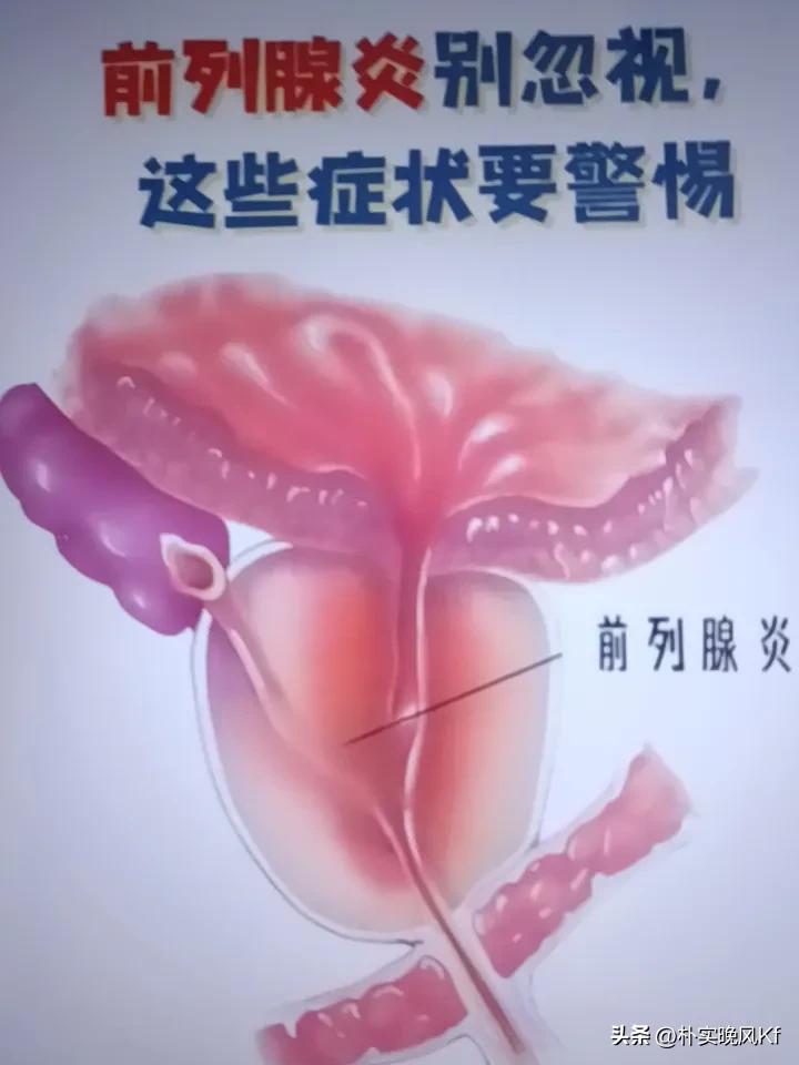 患有前列腺炎能不能熬夜?
我患前列腺炎有二三十年了。吃过“非那雄胺”、“普乐安片