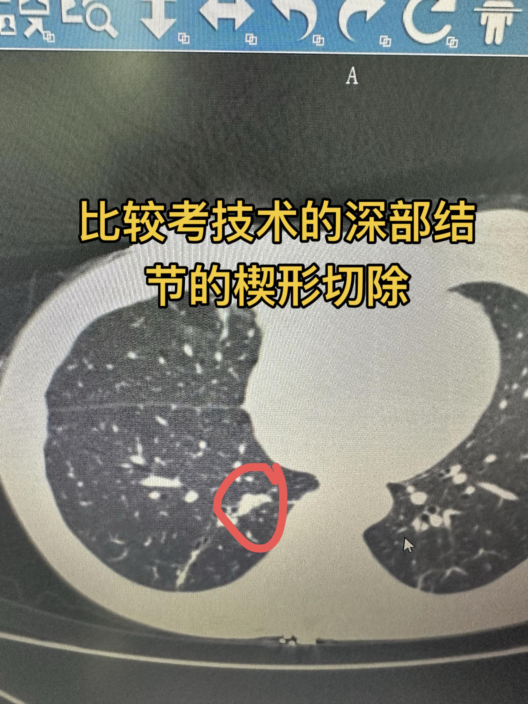 靠近下肺静脉结节的楔形切除。楔形切除，听着简单，但是有很难。难得楔形切...
