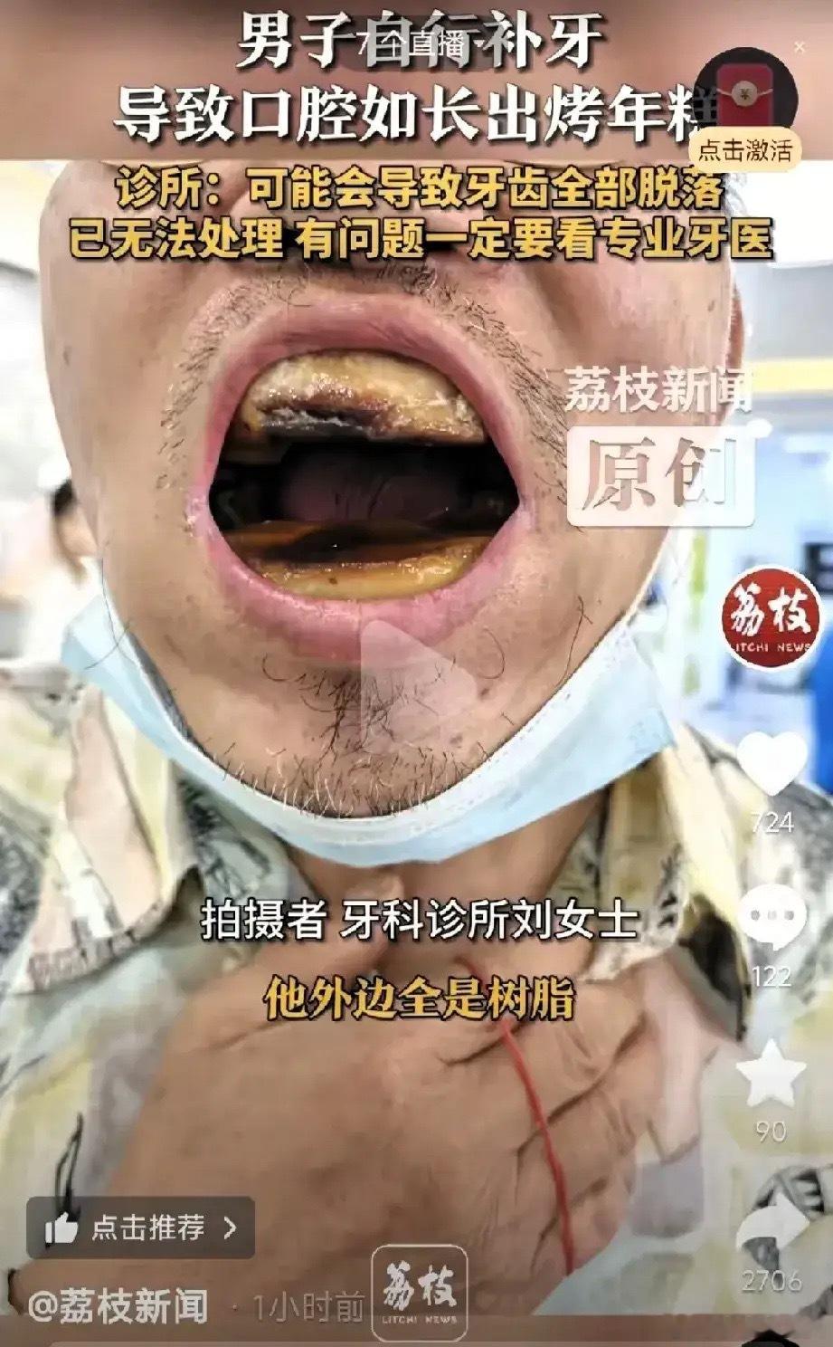 天津，一男子到牙科诊所拨牙，不料，一张嘴吓得医生后退两步，只见到如年糕似的牙床，