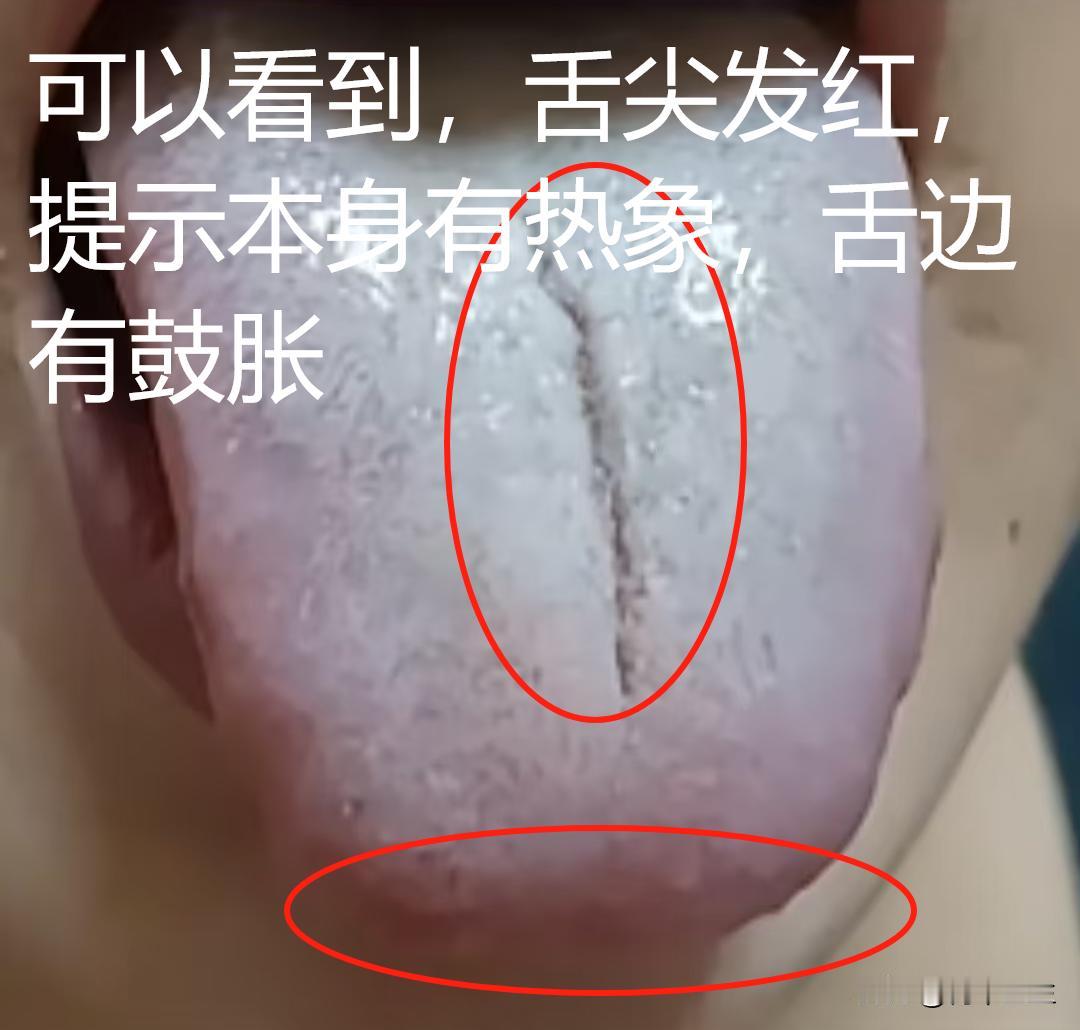 遇到这样的舌头真的让人很犯难，太难补了，有这样的情况一定要注意
这位粉丝朋友是怎