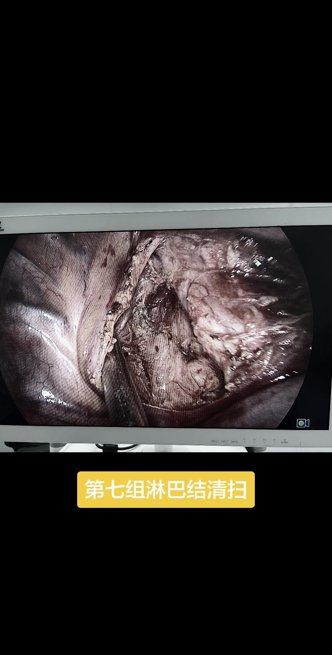 浸润性腺癌，系统性清扫……
