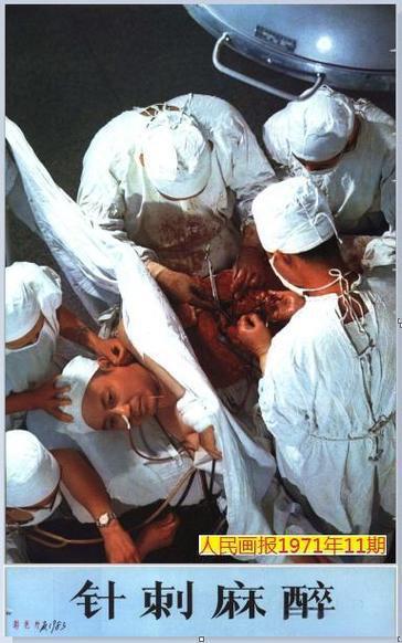 今天给一位75岁的奶奶做右侧腹股沟疝手术，她40年前做过左侧腹股沟疝，当时使用的