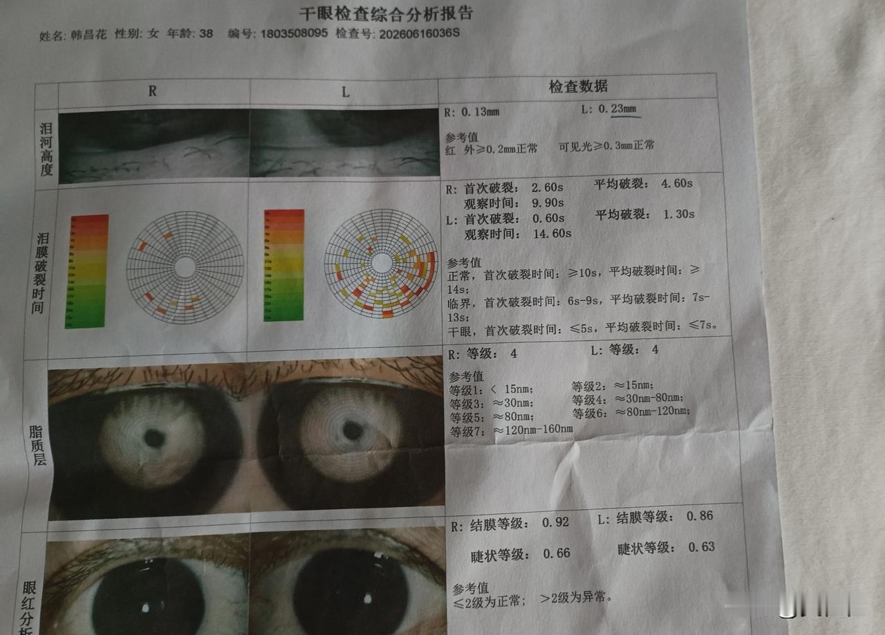 也记不起我是哪一年在西宁查出的干眼症，大夫让我用“爱丽丝地夸磷索钠滴眼液”。直到