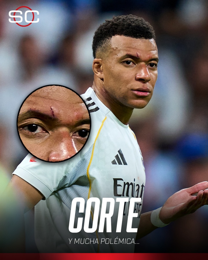 脸部挂彩！TA：姆巴佩预计能首发出战皇马对拜仁的欧冠