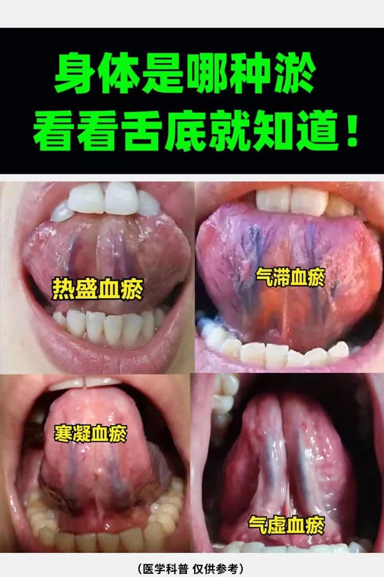 生气多不多，身体堵不堵，看舌底就知道[中国赞]
说到血瘀，大家的第一印象是什么？