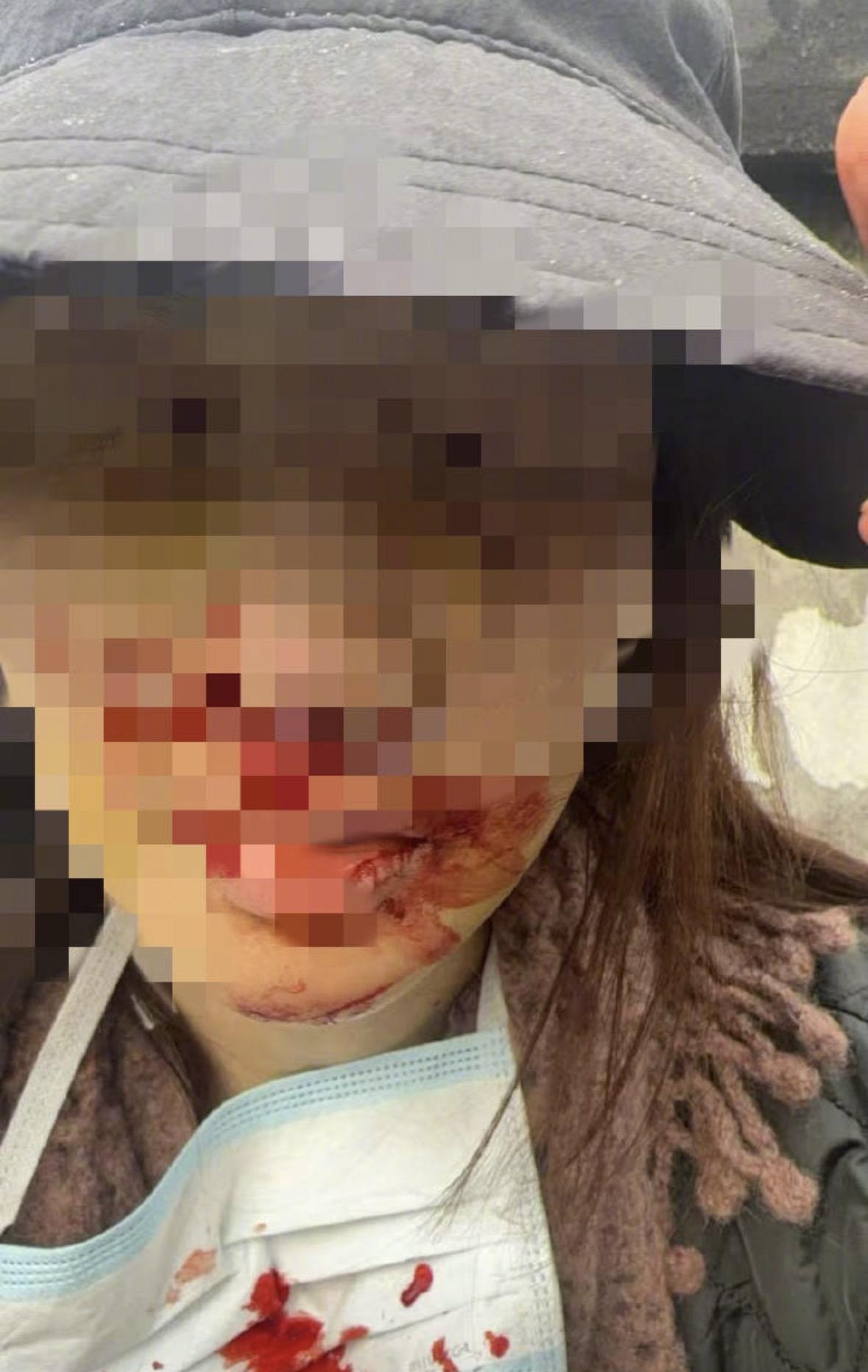 金晨晒伤脸佐证为何急于离开车祸现场：系去医院急救，毕竟是艺人，脸为职业财产。
助