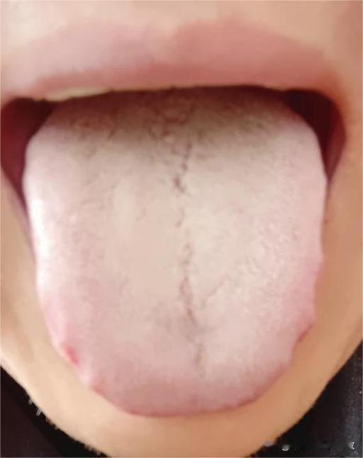 你舌面白成这样，就是再虚再着急，也不要先补阳，只会越补越虚[流泪][流泪]
这个