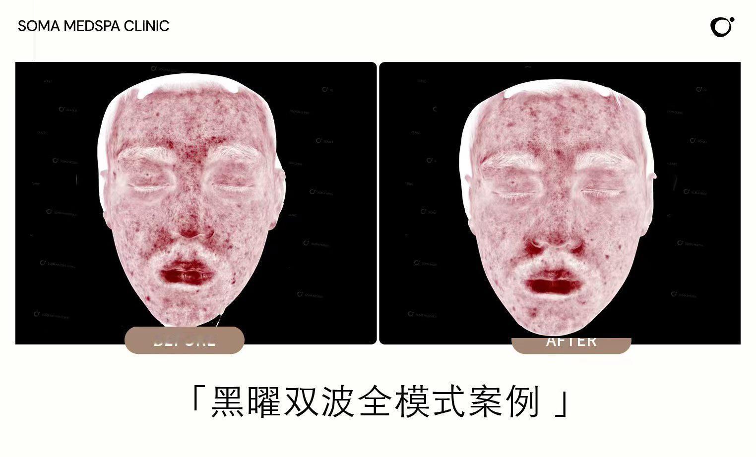 仔细说说黄金微针里 美迪迈、黑曜双波的区别。美迪迈更适合需要深度收紧、严重油痘肌