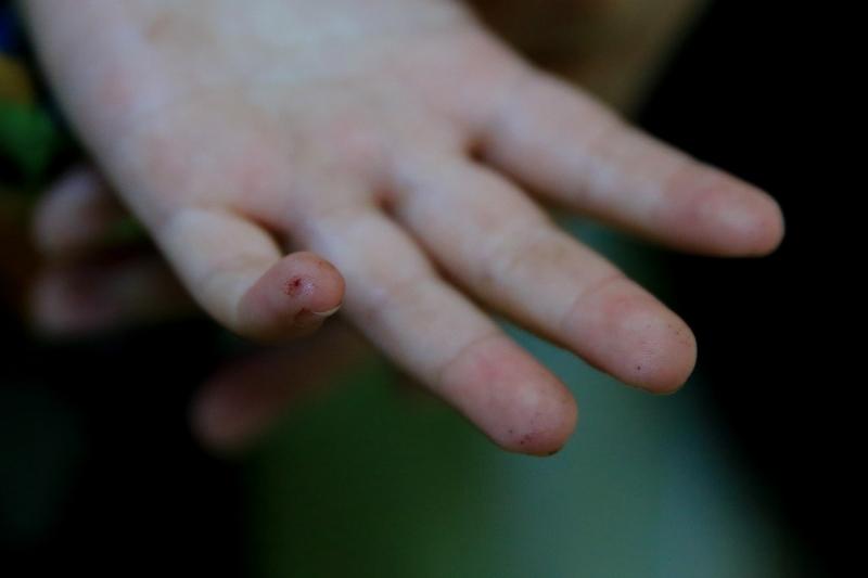 糖友不仅要控糖更要防“疹”
糖友们可别只盯着血糖，还得防“疹”！糖尿病易引发皮肤