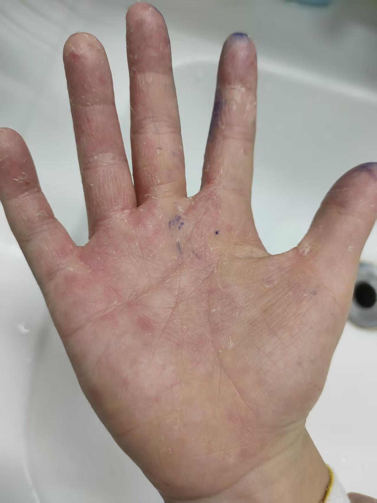 儿子有个怪毛病，

每过一段时间

就复发

这个毛病很少有人有，

他的手爱脱