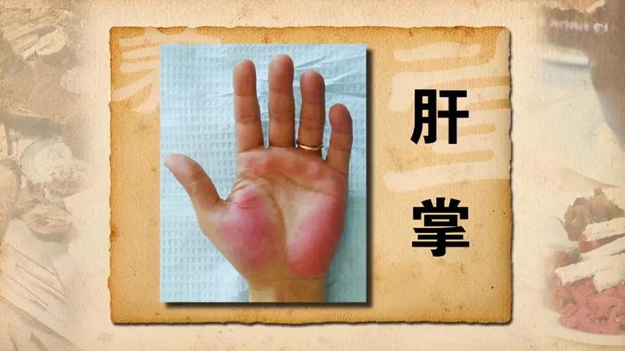肝掌是肝损伤到什么程度了？

在医学上，我们常常以一系列的体征和症状来评估疾病的