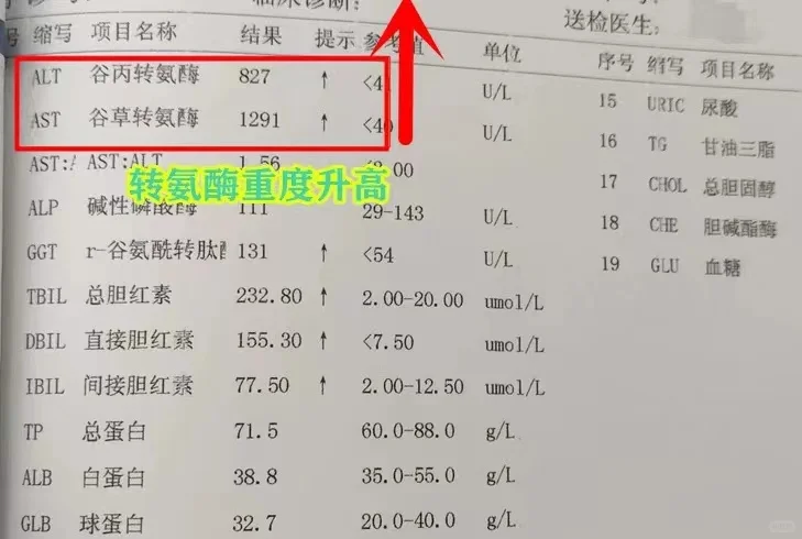 肝病患者注意一下，当转氨酶超过正常上限的10倍以上，也就是大于400时...