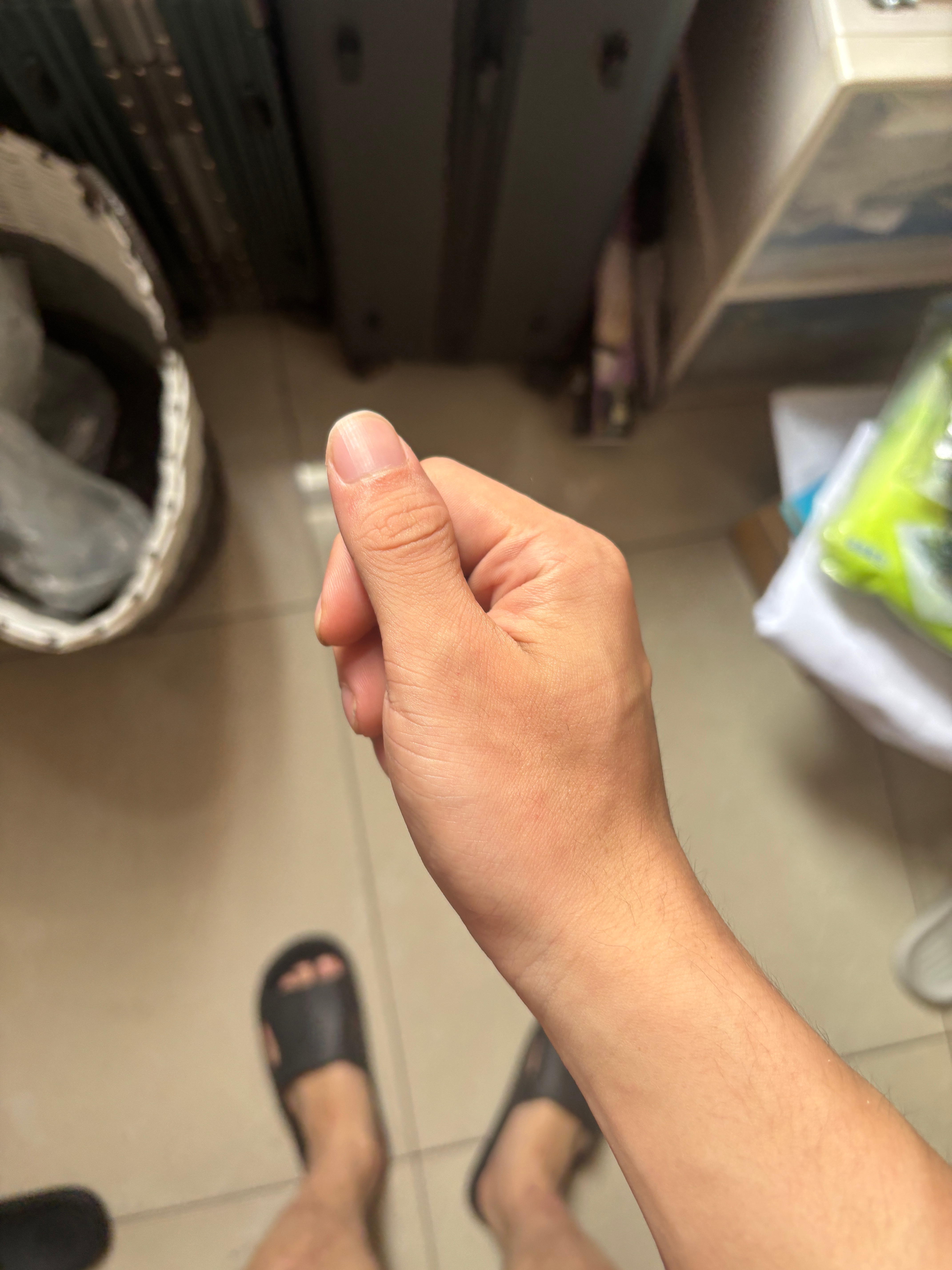 一大早发现自己病了 攀岩的时候大拇指侧着杵到了地上（没有直勾勾的） 然后昨天小疼