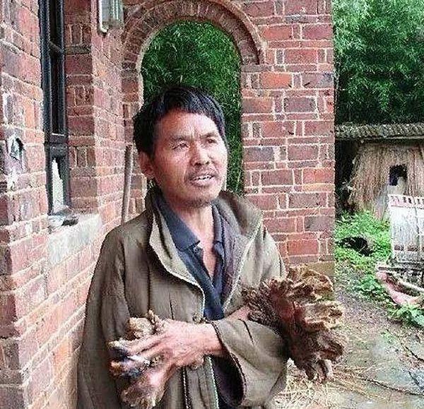 “到底是树还是人？”2016年，记者采访湖南一男子，他表示自己一到深夜就抽搐直冒