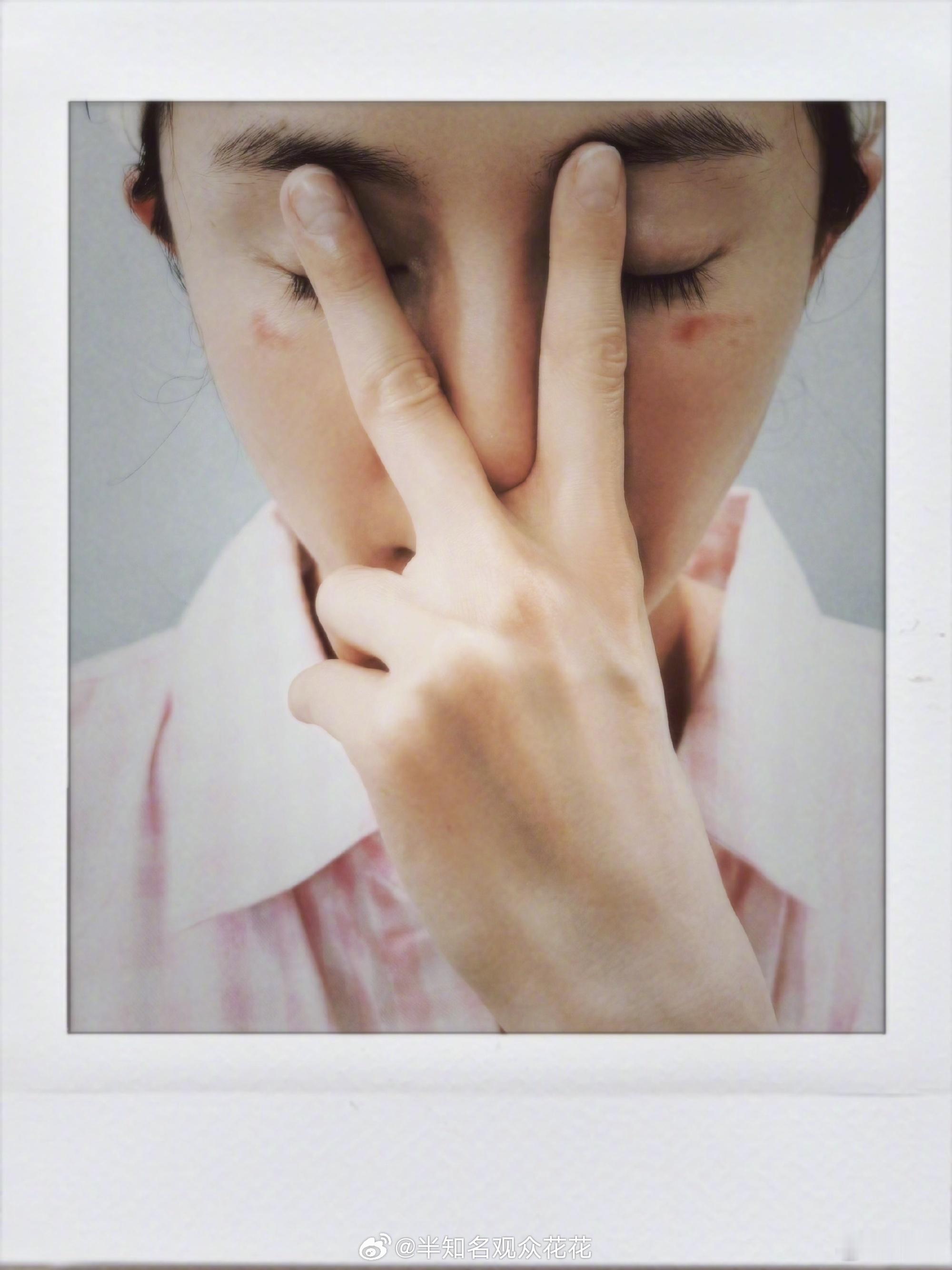 使用蒸汽眼罩需要小心杨幂脸被蒸汽眼罩烫伤了杨幂说蒸汽眼罩咬我