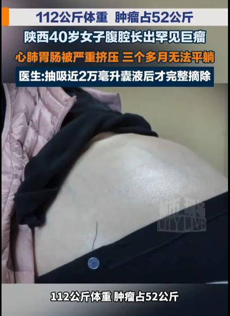 陕西西安，一名体重112公斤的40岁女子，腹腔竟取出重达52公斤的罕见巨瘤，占体