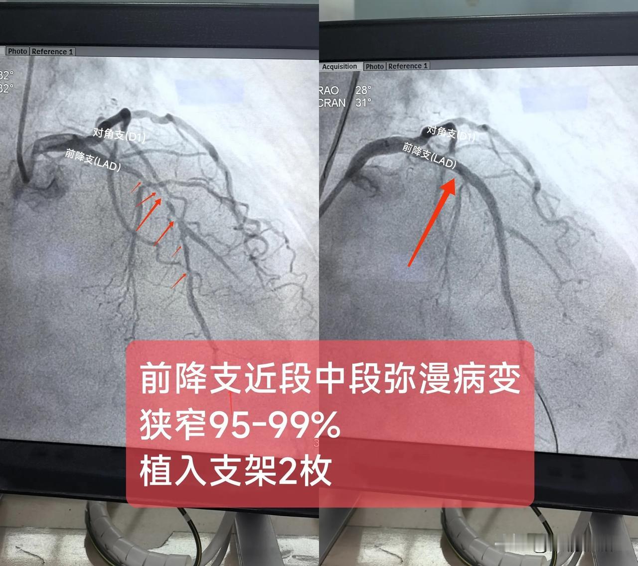 急性非ST段抬高型心肌梗死
(前降支近段中段弥漫病变
狭窄95-99%)

一.