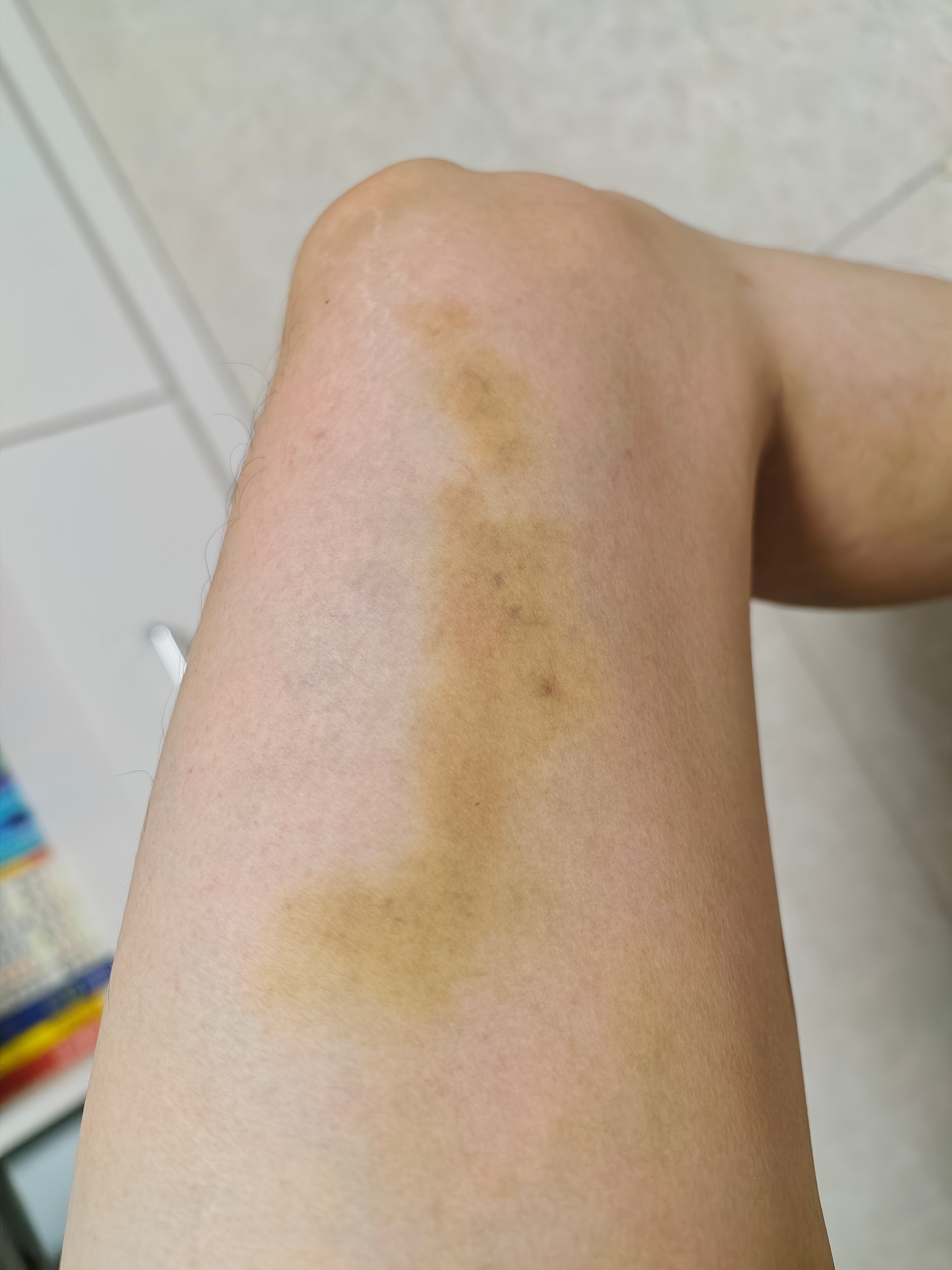年轻人不讲武德，踢球力气太大了[揣手]腿上大块的淤青有两处，小块的还有四五处。。