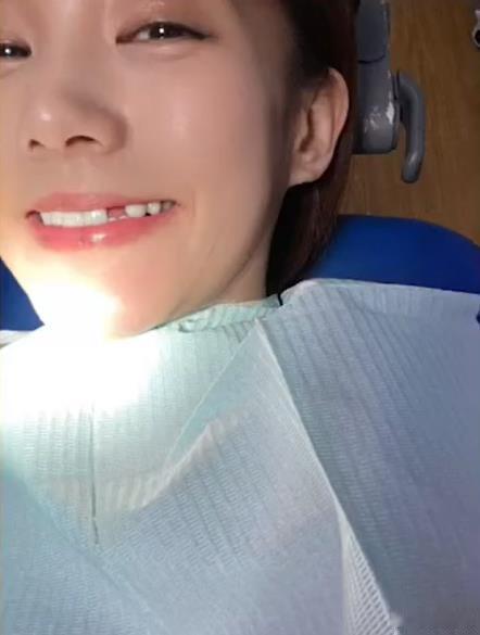 李一桐被磕掉了一颗牙 娱乐圈双璧之一，笑眼女神李一桐在节目里自曝拍打戏被撞掉一颗
