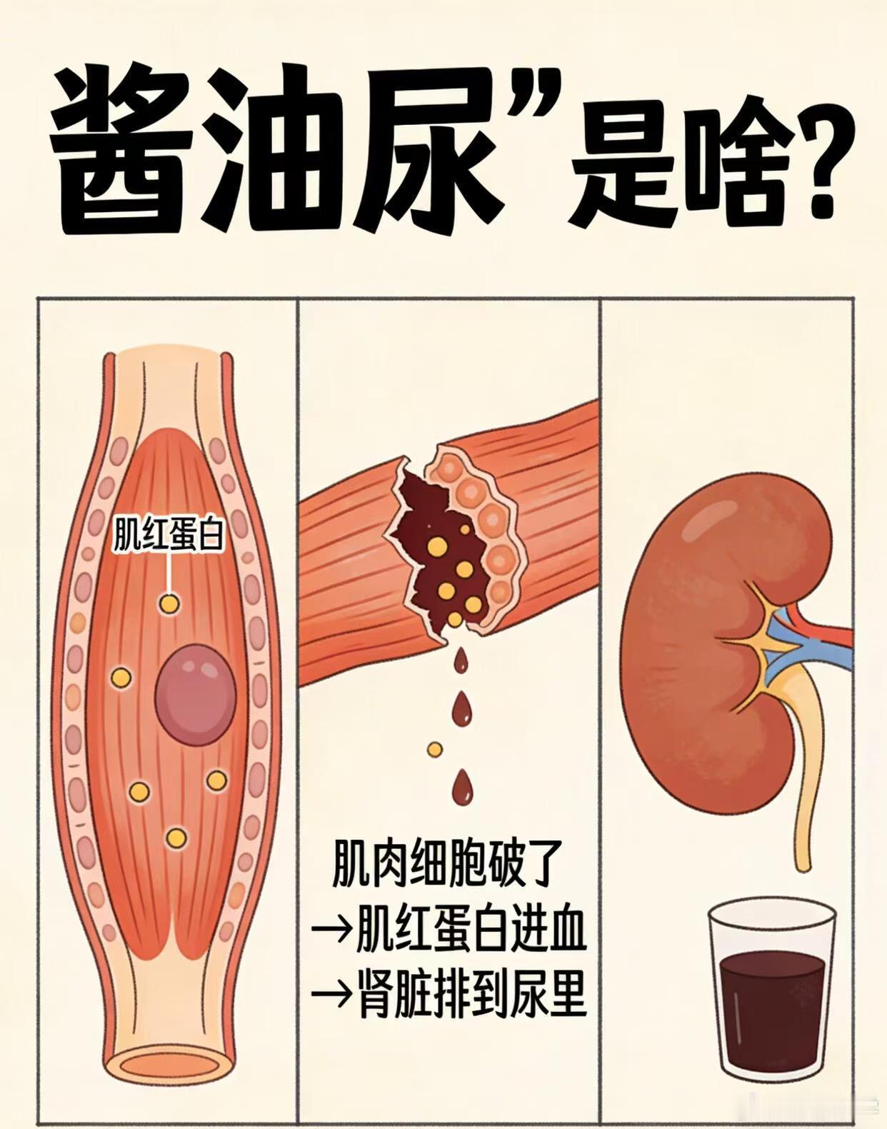 女子运动过度确诊横纹肌溶解 健身猛人注意！尿液变这个颜色，马上停今天多蹲几组腿、