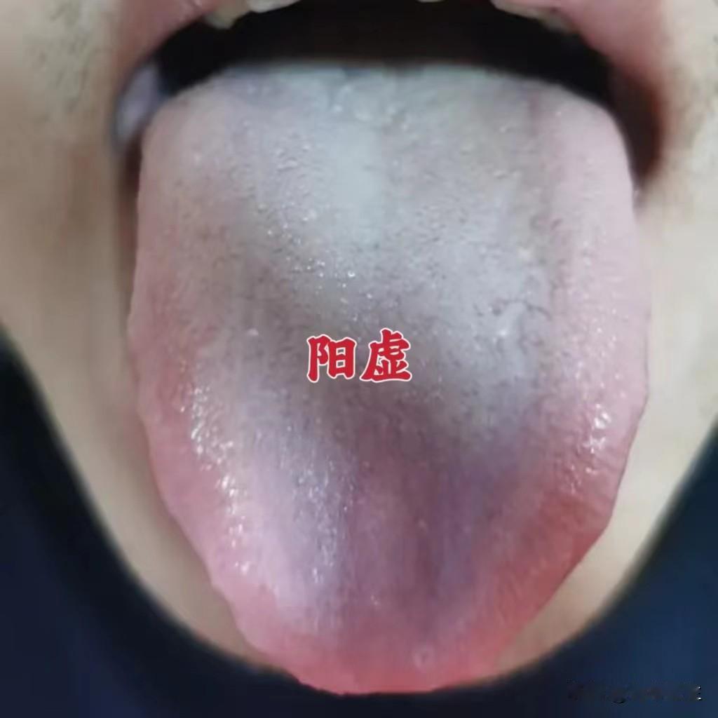 今日舌诊总结：
（一）脾肾阳虚 寒凝成瘀 气血不足
症状：舌色淡，舌中、舌根苔白