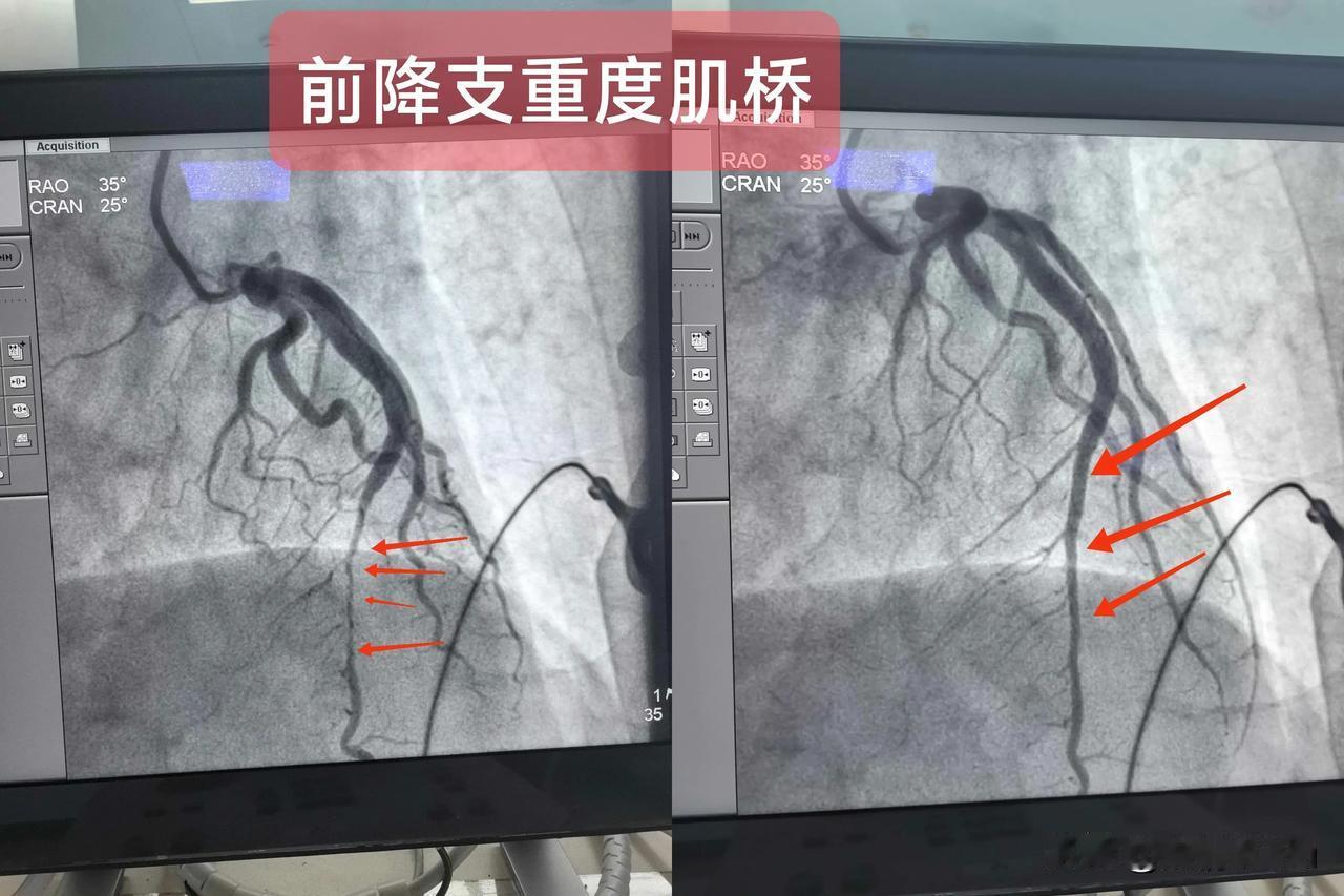 急性非ST段抬型心肌梗死
(前降支中段重度肌桥)
一.概念：
前降支主要为前壁及