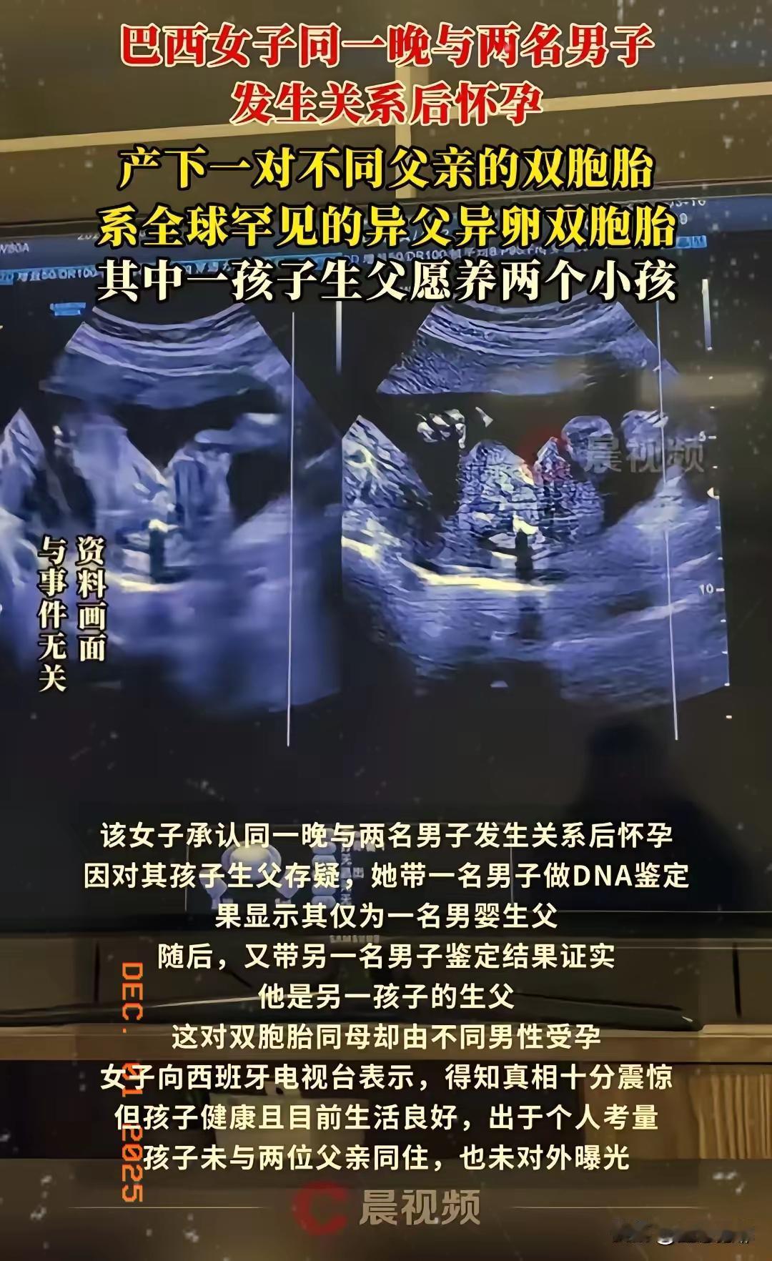 巴西，一女子同一天晚上和两名男子发生关系后怀孕，产下一对双胞胎，八个月后亲子鉴定