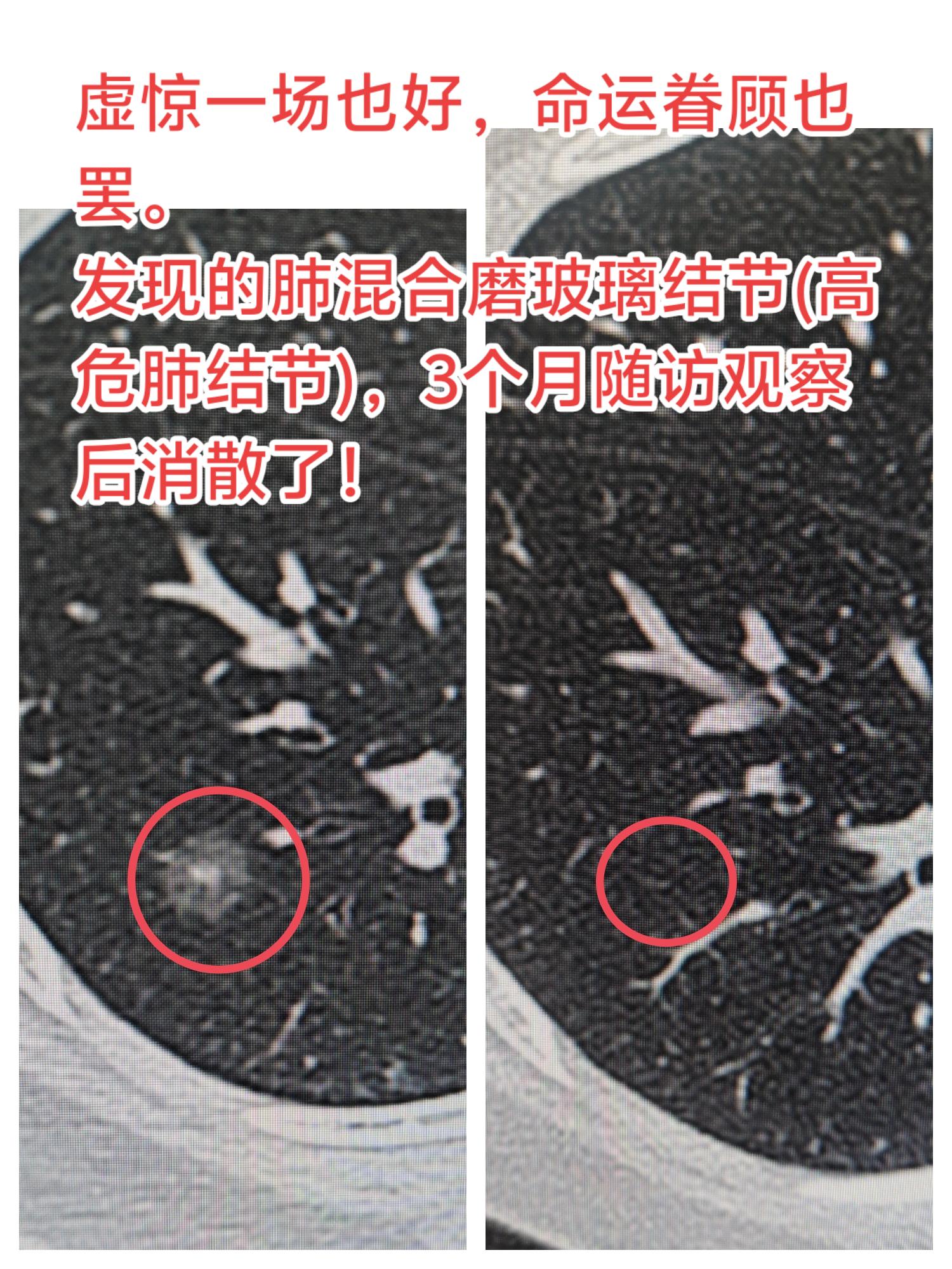 肺结节随访消散了。发现的肺混合磨玻璃结节(高危肺结节)，3个月随访观察后消散了！