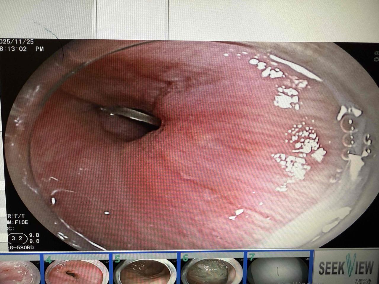 聚餐吃鱼，边吃边开玩笑，然后鱼骨头就吞下去扎入食管！
关键词：聚餐，吃鱼，开玩笑