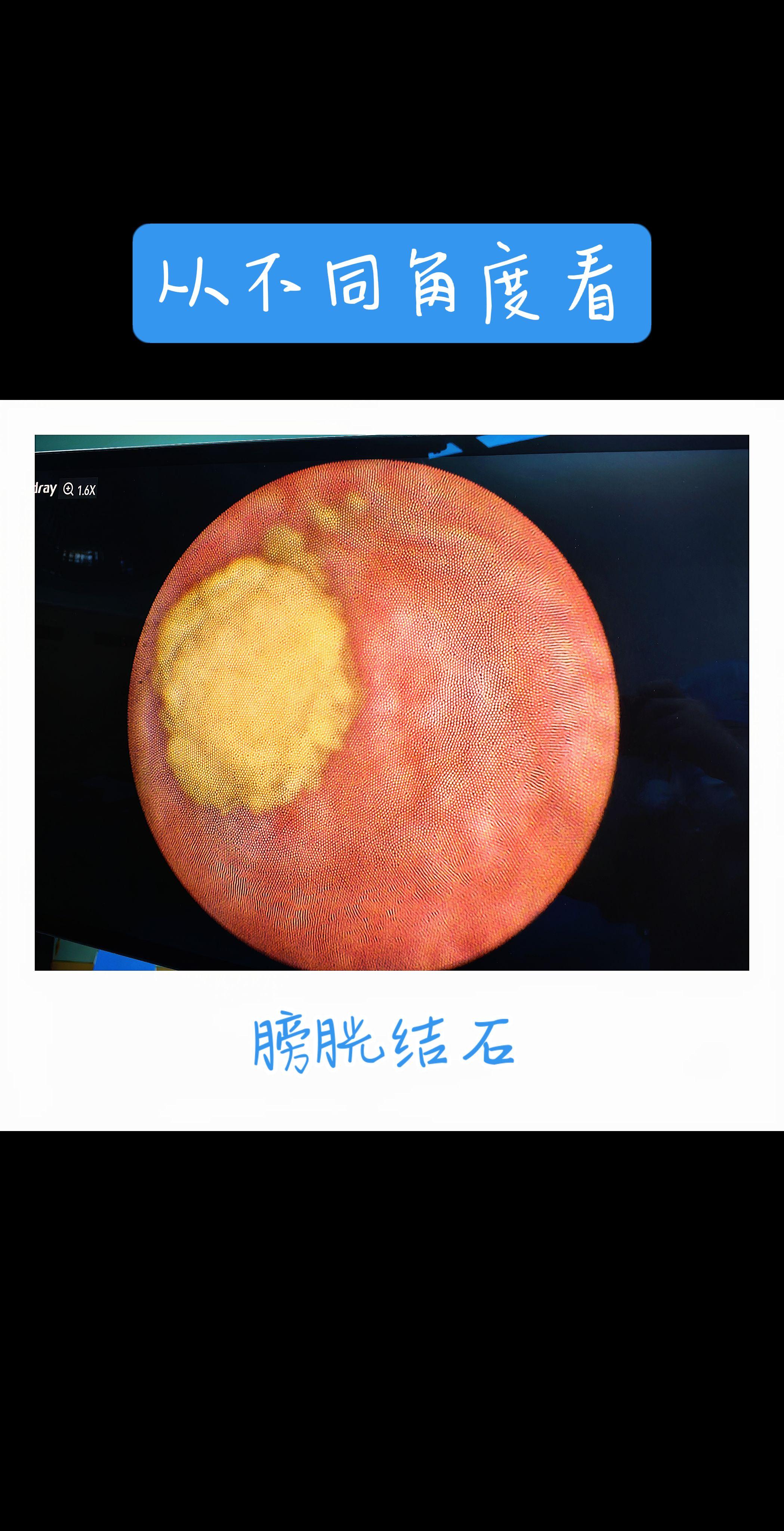 从不同角度看膀胱结石。膀胱结石，多是“憋”出来和“浓”出来的。 · 尿...
