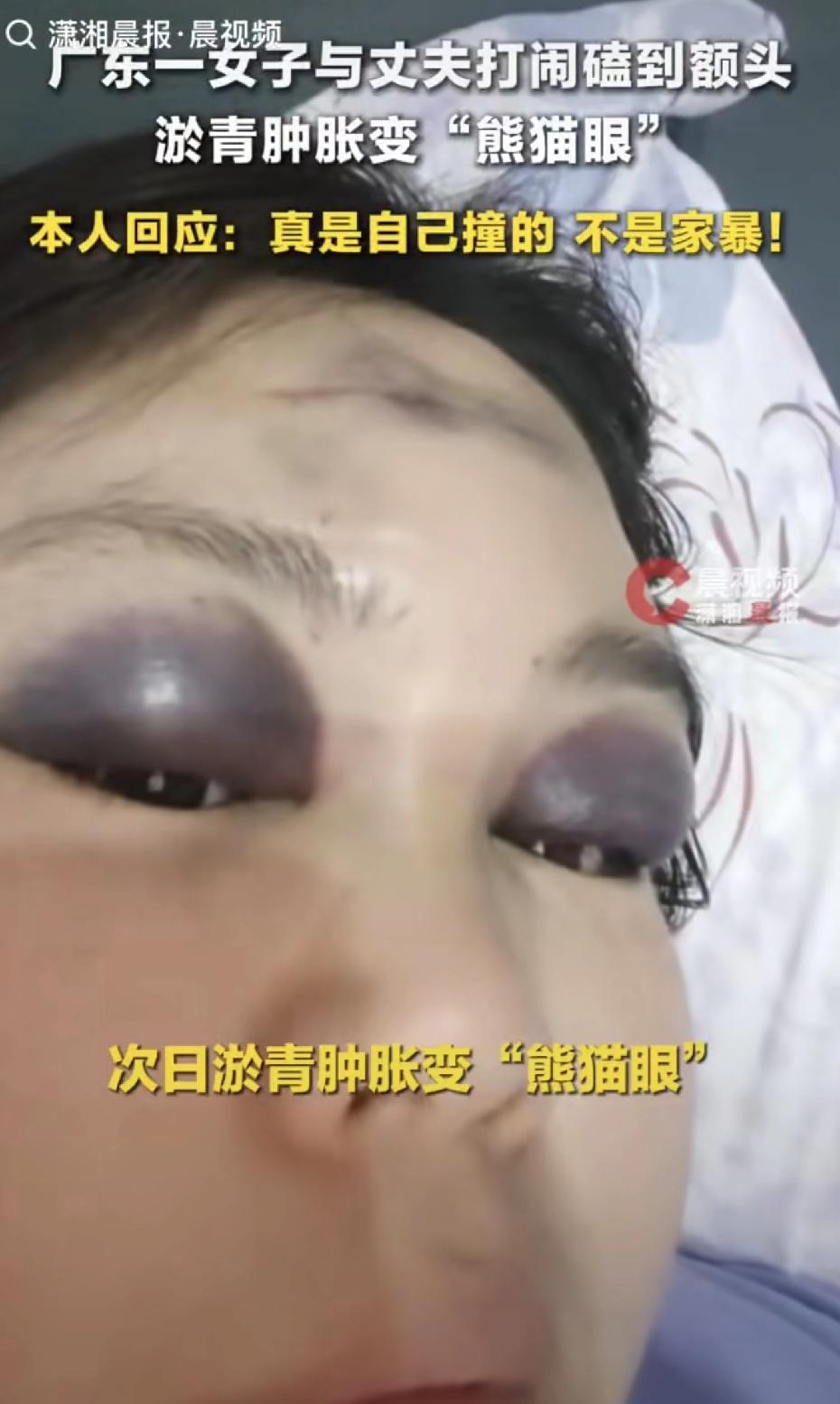 广东一女子晚上跟老公打闹笑到失控，第二天醒来她差点没认出自己：这熊猫眼也太冤了。
