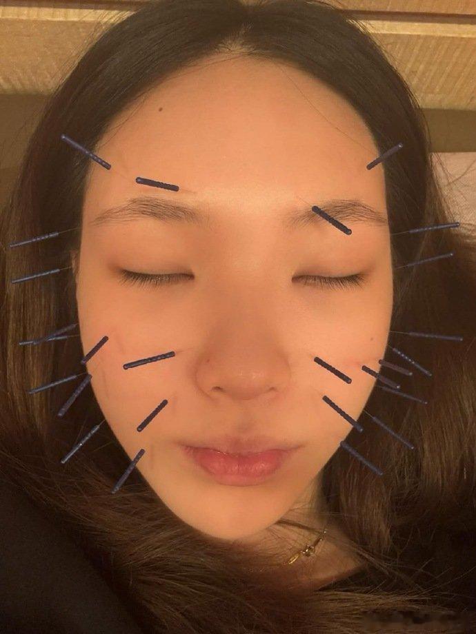 小S大女儿针灸拔罐小S大女儿迷上针灸拔罐 小S大女儿针灸拔罐，把身体保养放在第一