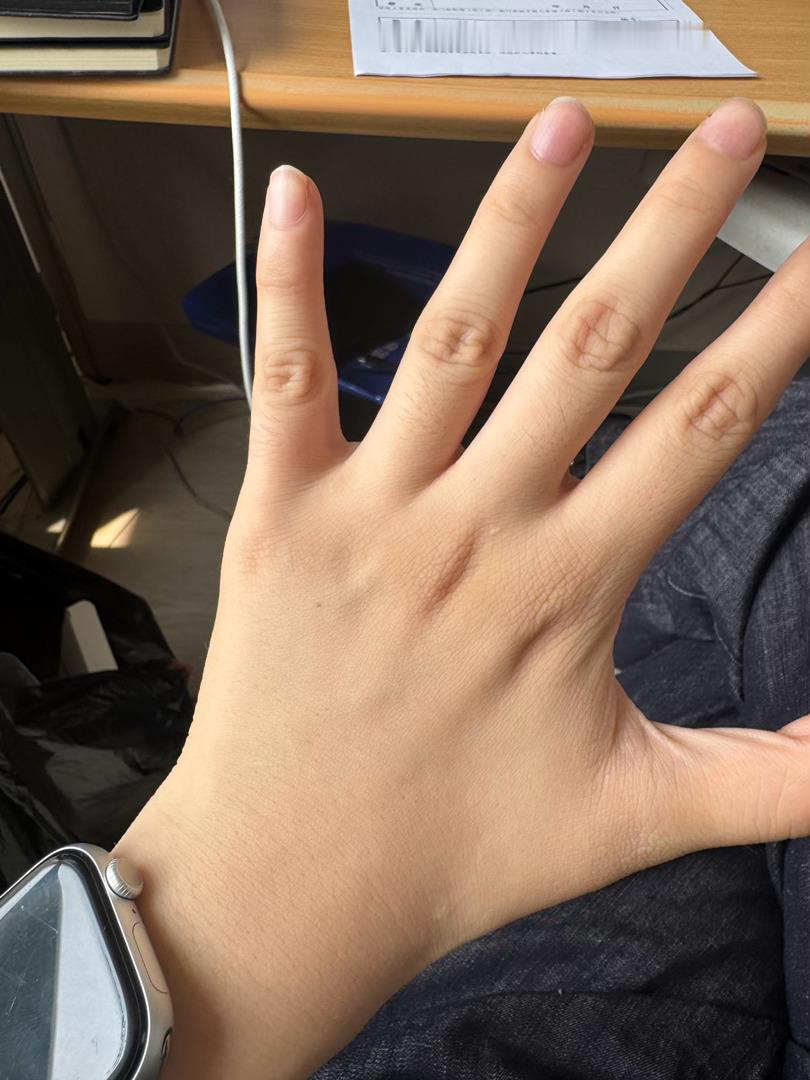 什么时候能瘦到手上没有坑 