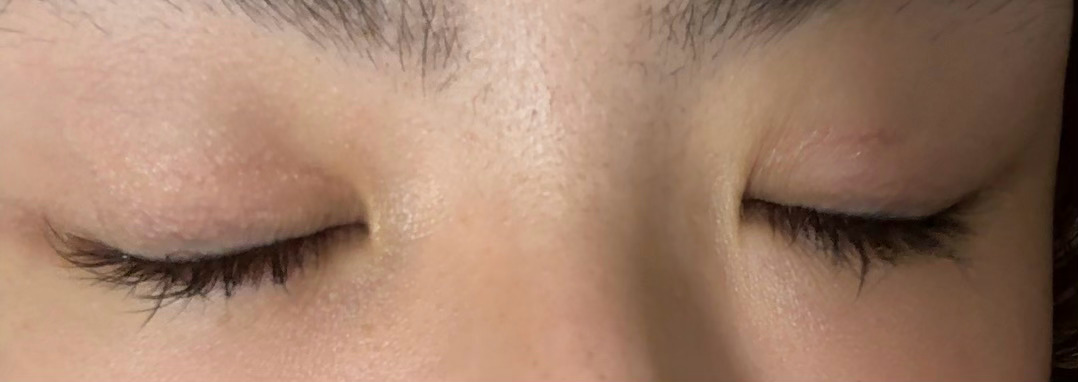 给姐妹分享眼角疤痕恢复。我突然发现，我的两边的内眦赘皮牵拉度是完全不一样的。我第