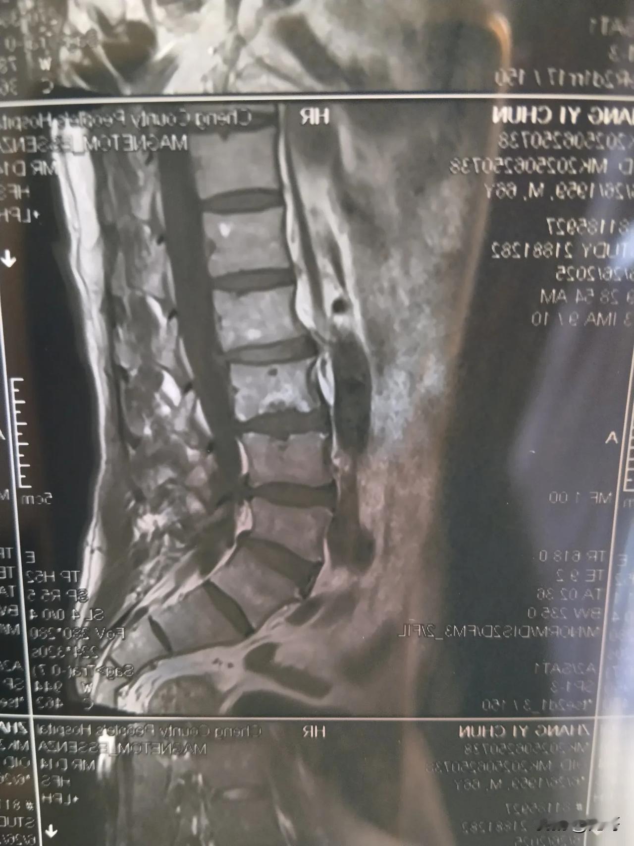 26岁，腰突了！职场人崩溃瞬间：一位00后的自白！

你以为“腰突”是爸妈辈的专