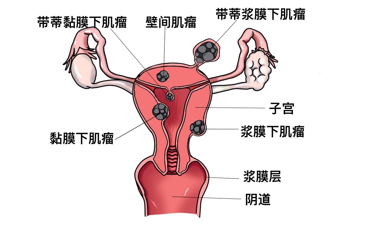 我在妇科复查时，发现子宫肌瘤变大了，医生建议我切除。回想起前几年和前任谈的恋爱，