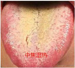 汗从哪出，病从哪来，这几个地方出汗多，千万要注意
1. 头汗
表现：头汗多、黏糊
