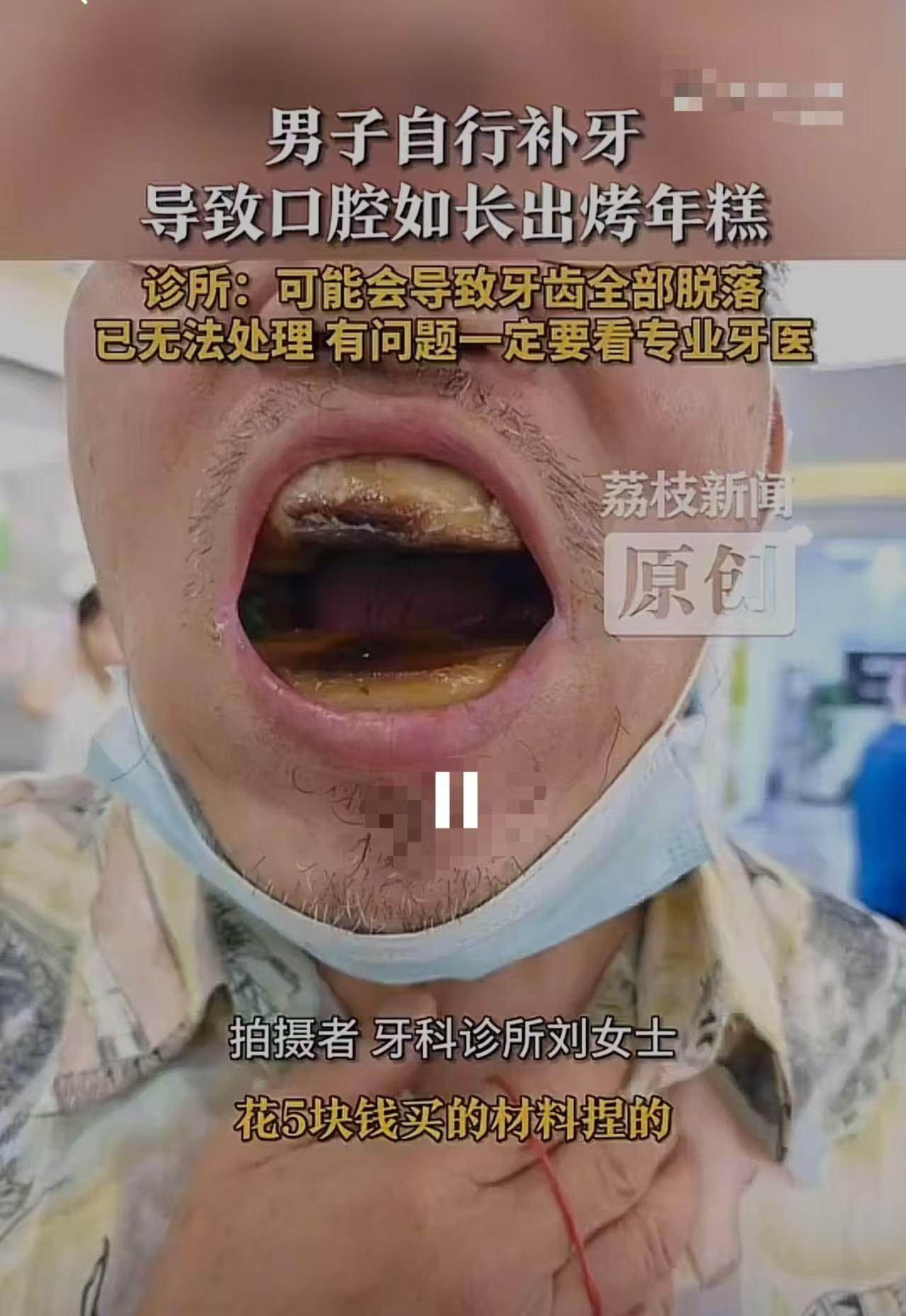 太心酸了！天津，大叔去口腔科看牙齿，嘴巴一张开把医生吓了一大跳，牙齿全部变形，口